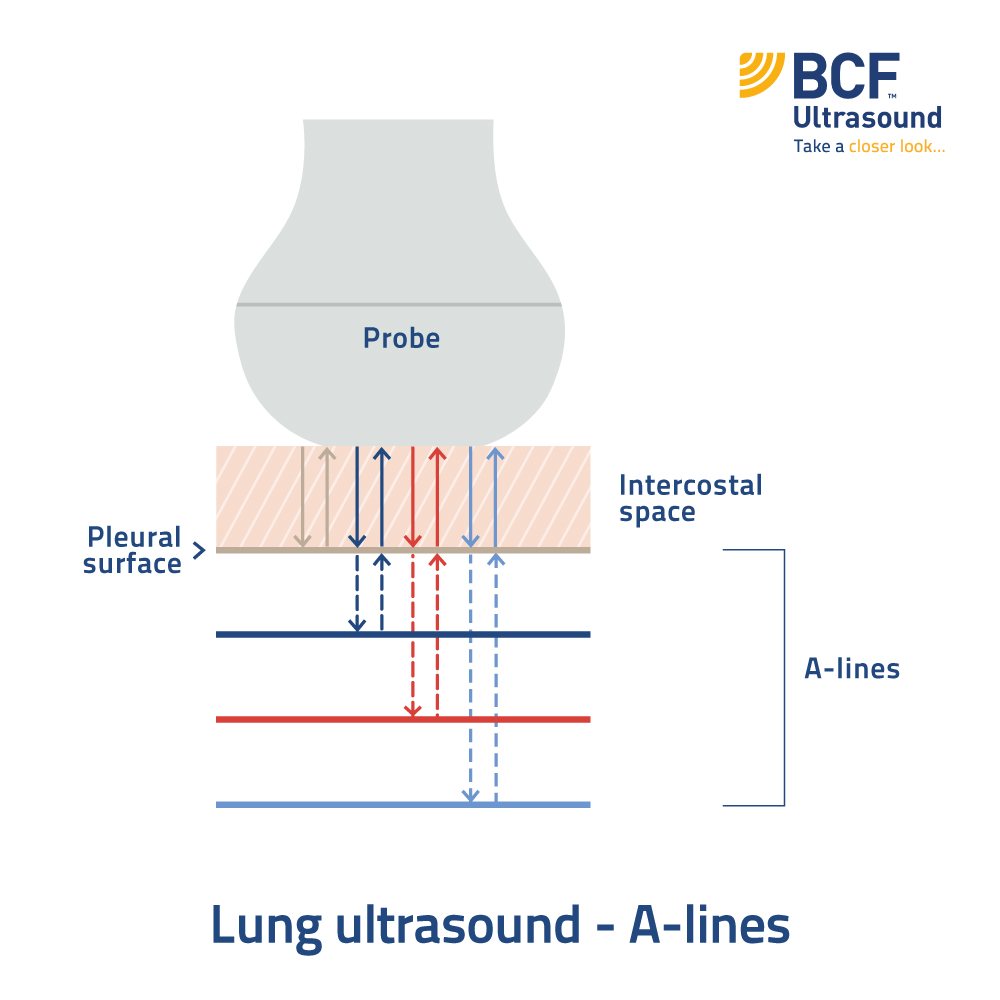 ABCs of Lung Ultrasound | A is for… A-lines