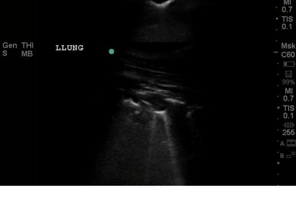 lung ultrasound consolidation