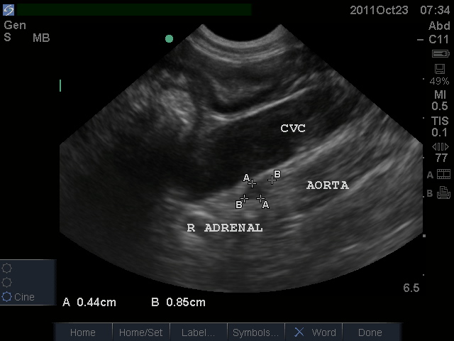 Canine Right Adrenal with Aorta & CVC: Sonosite M-turbo with c11x probe